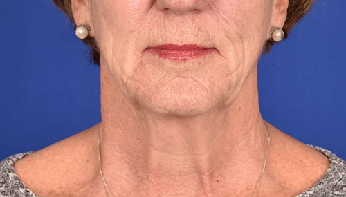 Case--4075 | Before Facelift / Neck Lift