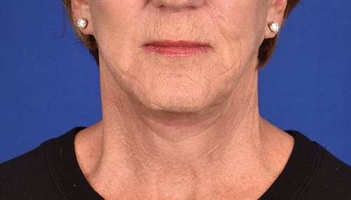 Case--4075 | After Facelift / Neck Lift