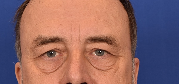 Case--5121 | Before Blepharoplasty