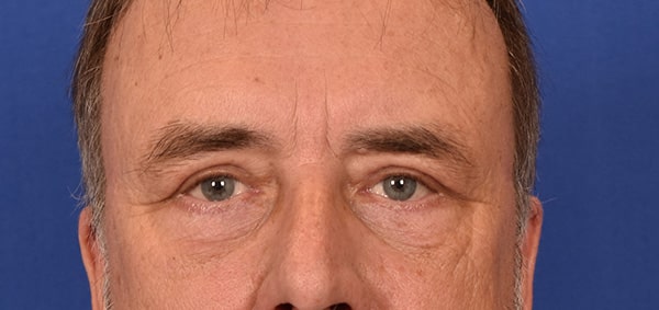 Case--5121 | After Blepharoplasty
