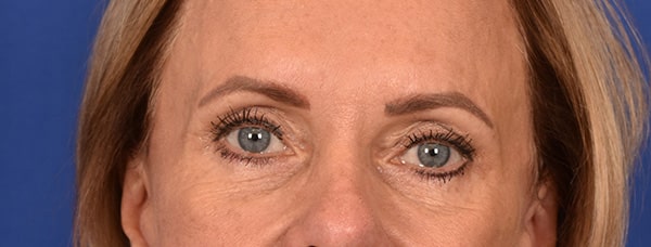 Case--4849 | After Blepharoplasty