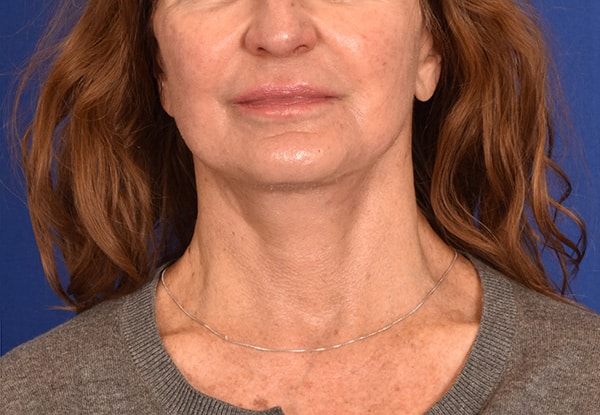 Case--3212 | After Facelift / Neck Lift