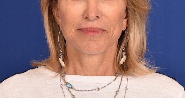 Case--2279 | After Facelift / Neck Lift