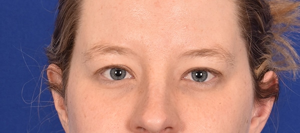 Case--8561 | Before Blepharoplasty