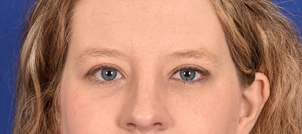 Case--8561 | After Blepharoplasty