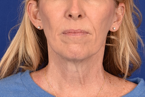 Case--8648 | Before Facelift / Neck Lift