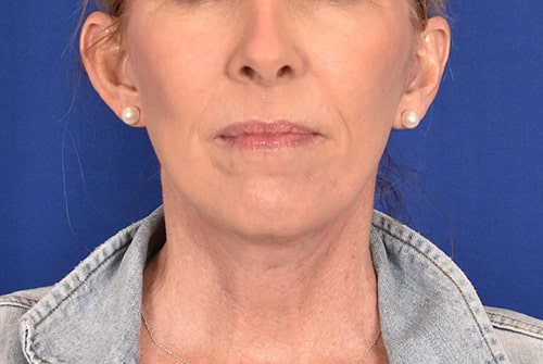 Case--8648 | After Facelift / Neck Lift