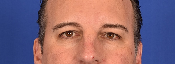 Case--9833 | Before Blepharoplasty