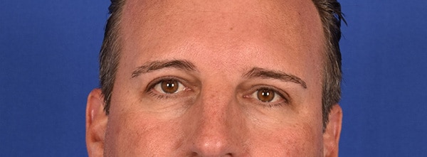 Case--9833 | After Blepharoplasty