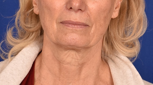 Case--1350 | Before Facelift / Neck Lift