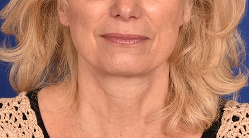 Case--1350 | After Facelift / Neck Lift