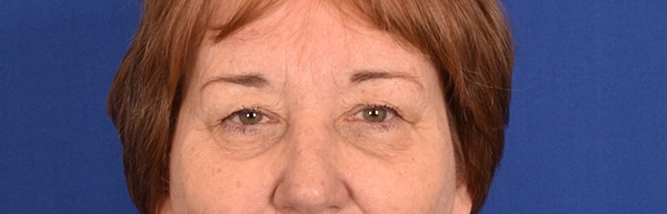 Case--9728 | Before Blepharoplasty