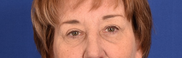Case--9728 | After Blepharoplasty
