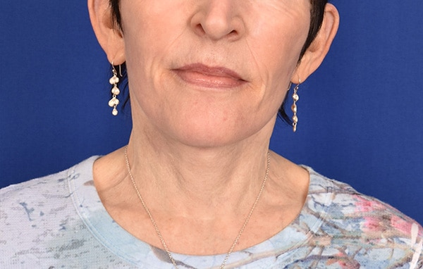 Case--6867 | After Facelift / Neck Lift