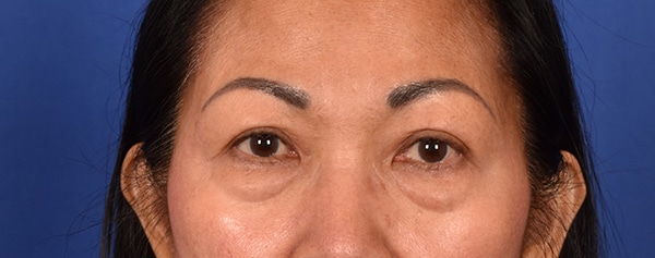 Case--7084 | Before Blepharoplasty