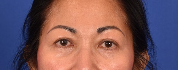 Case--7084 | After Blepharoplasty