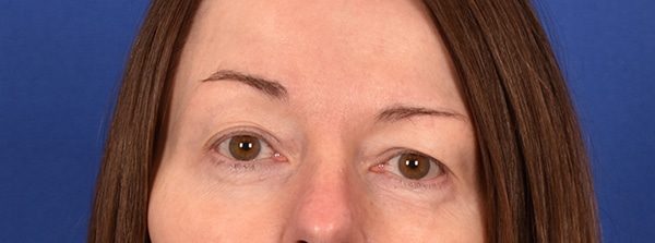 Case--2105 | Before Blepharoplasty