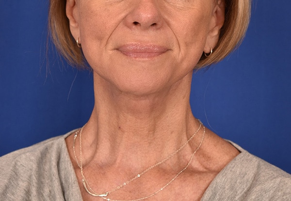 Case--9804 | After Facelift / Neck Lift