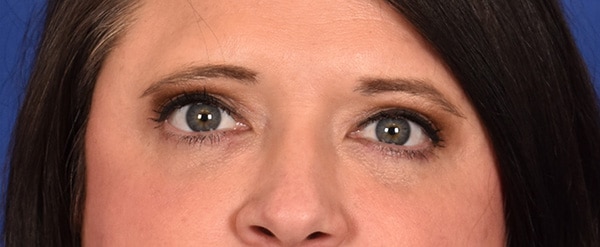 Case--5172 | After Blepharoplasty