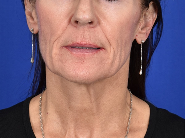 Case--7947 | Before Facelift / Neck Lift