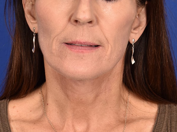 Case--7947 | After Facelift / Neck Lift