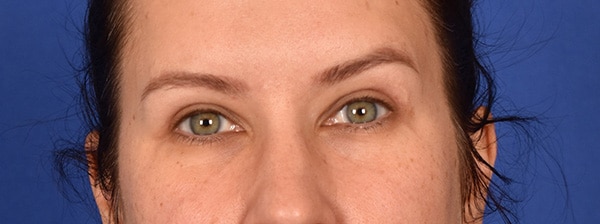 Case--6735 | After Blepharoplasty