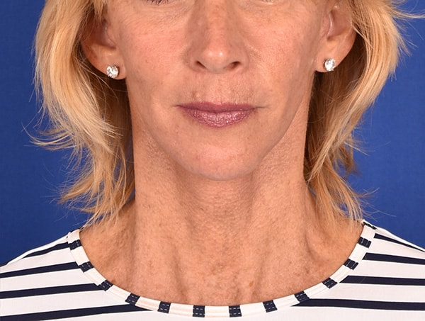 Case--8821 | After Facelift / Neck Lift