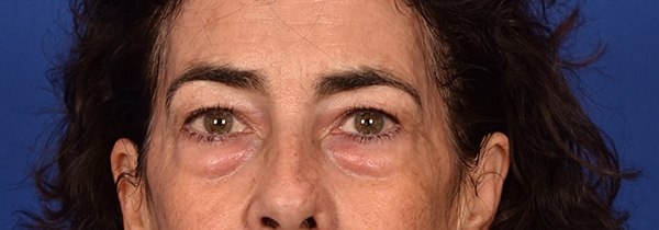 Case--2042 | Before Blepharoplasty