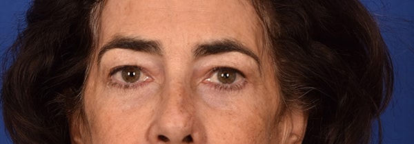 Case--2042 | After Blepharoplasty