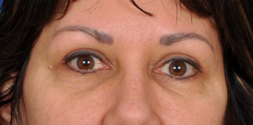 Case--1803 | After Blepharoplasty