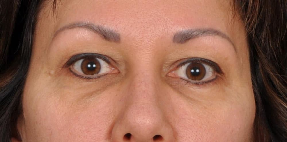 Case--1803 | Before Blepharoplasty