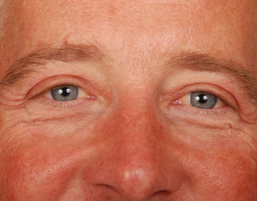 Case--9502 | After Blepharoplasty