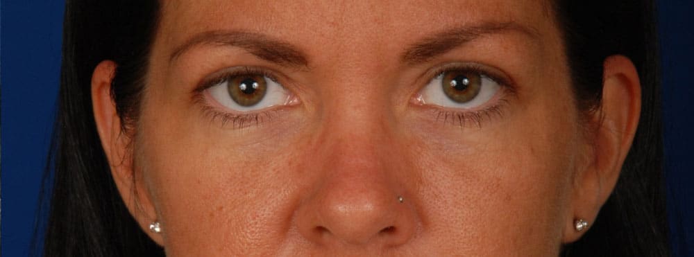 Case--1742 | After Blepharoplasty