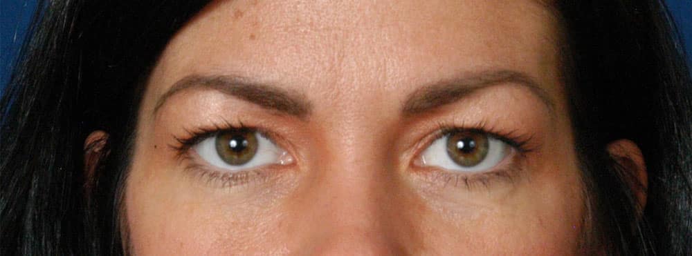Case--1742 | Before Blepharoplasty