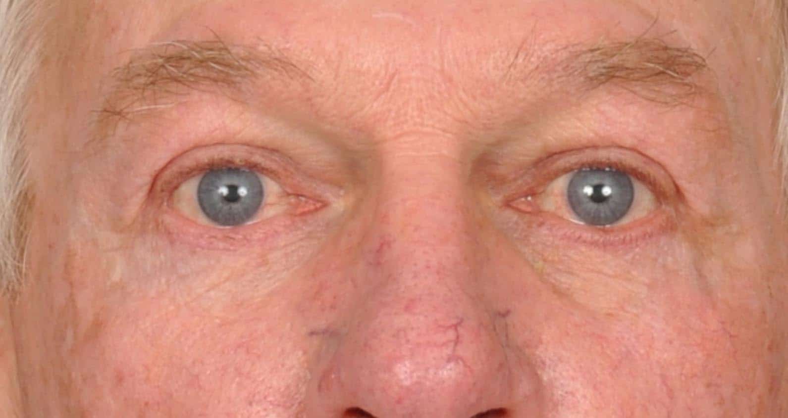 Case--2473 | After Blepharoplasty