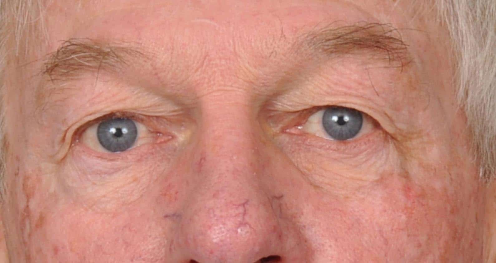 Case--2473 | Before Blepharoplasty