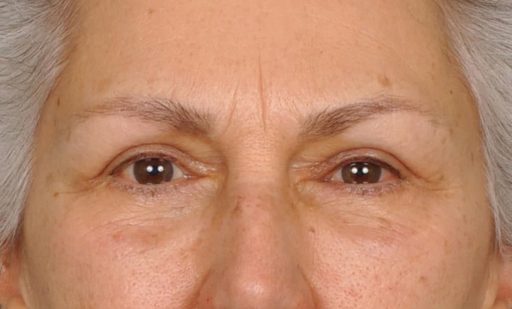 Case--7387 | After Blepharoplasty