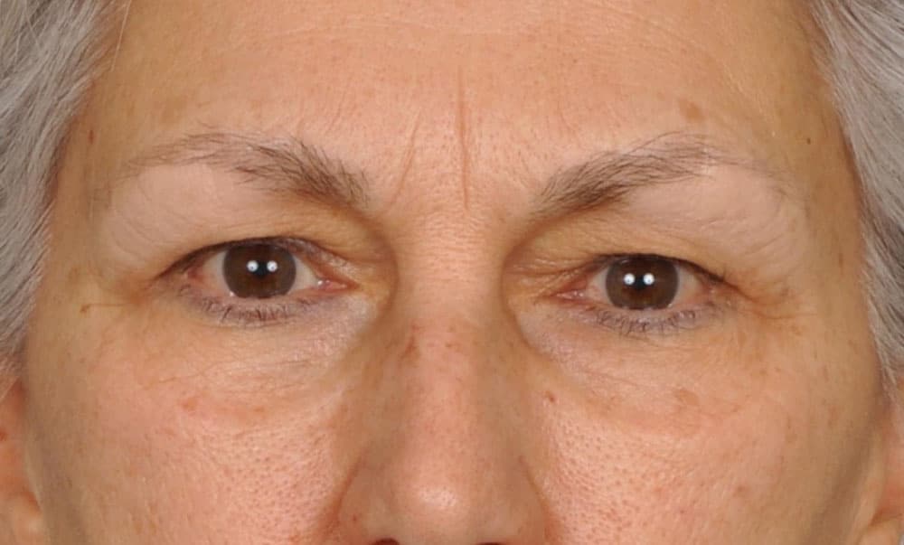 Case--7387 | Before Blepharoplasty
