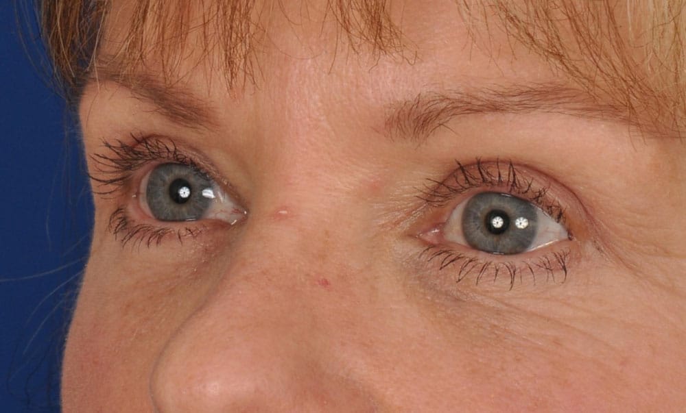 Case--1699 | After Blepharoplasty