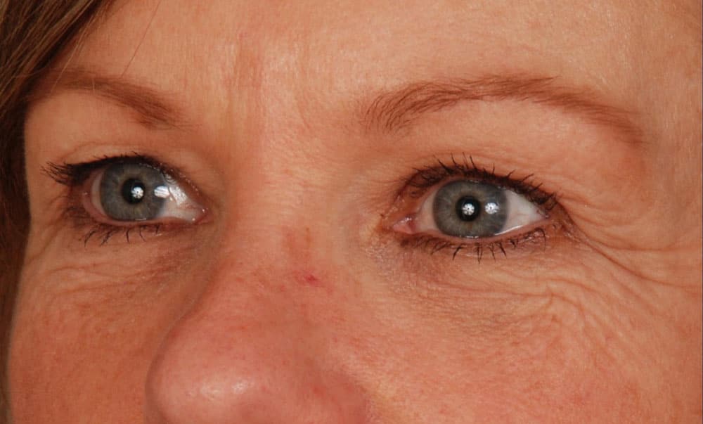 Case--1699 | Before Blepharoplasty