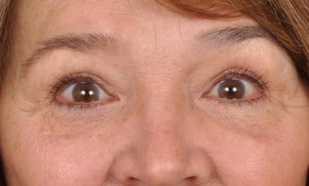 Case--1094 | After Blepharoplasty