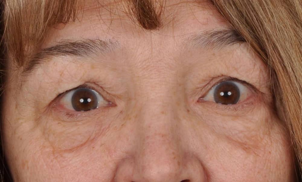 Case--1094 | Before Blepharoplasty
