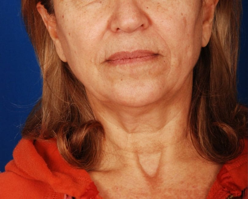 Case--4459 | Before Facelift / Neck Lift