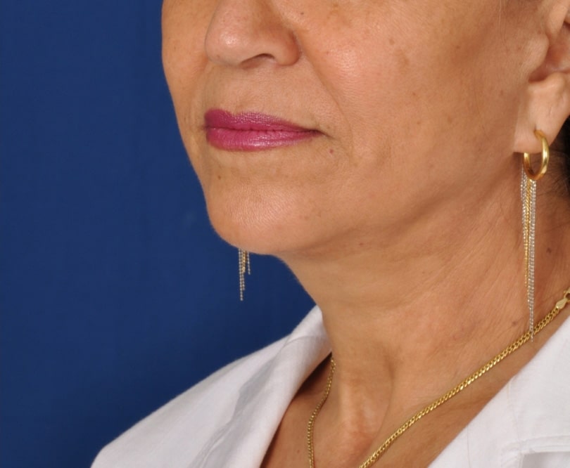 Case 4459 Denver Cosmetic Surgery Board Certified Plastic Surgeon