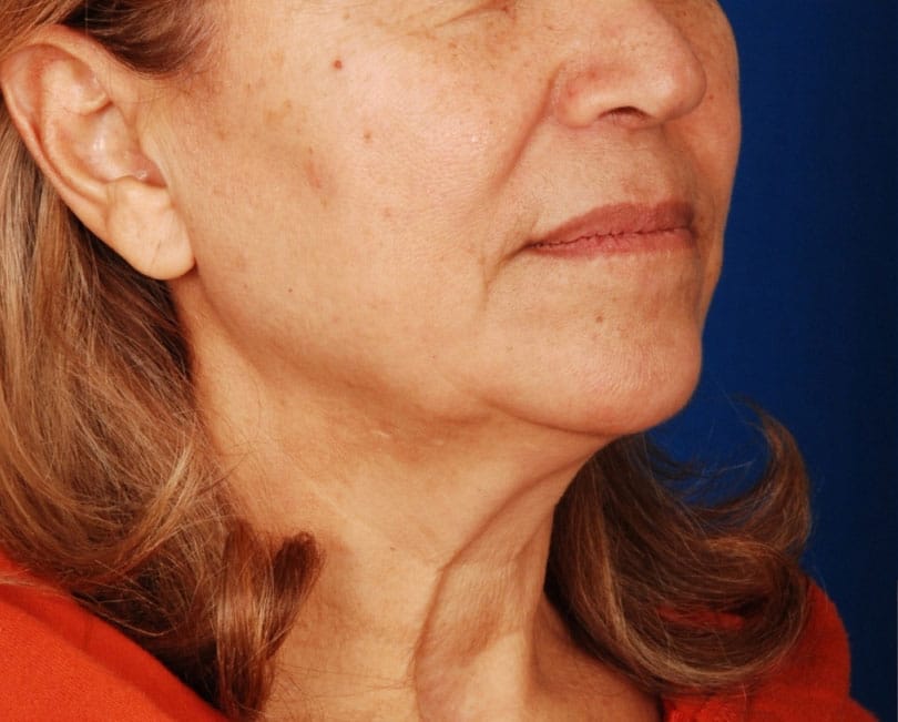 Case 4459 Denver Cosmetic Surgery Board Certified Plastic Surgeon