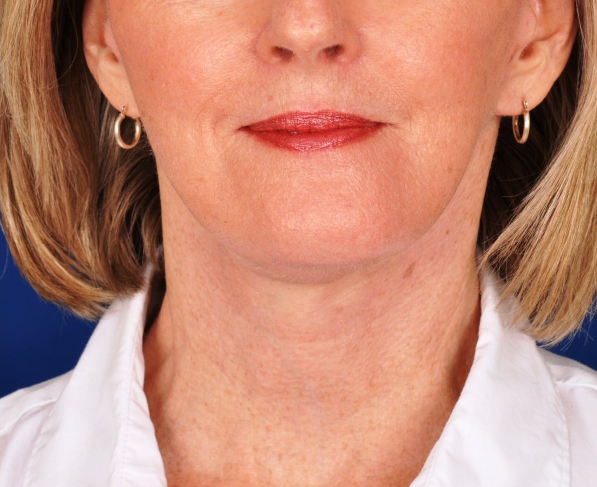 Case 4956 Denver Cosmetic Surgery Board Certified Plastic Surgeon