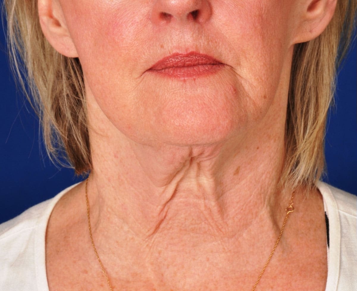 Case--4956 | Before Facelift / Neck Lift