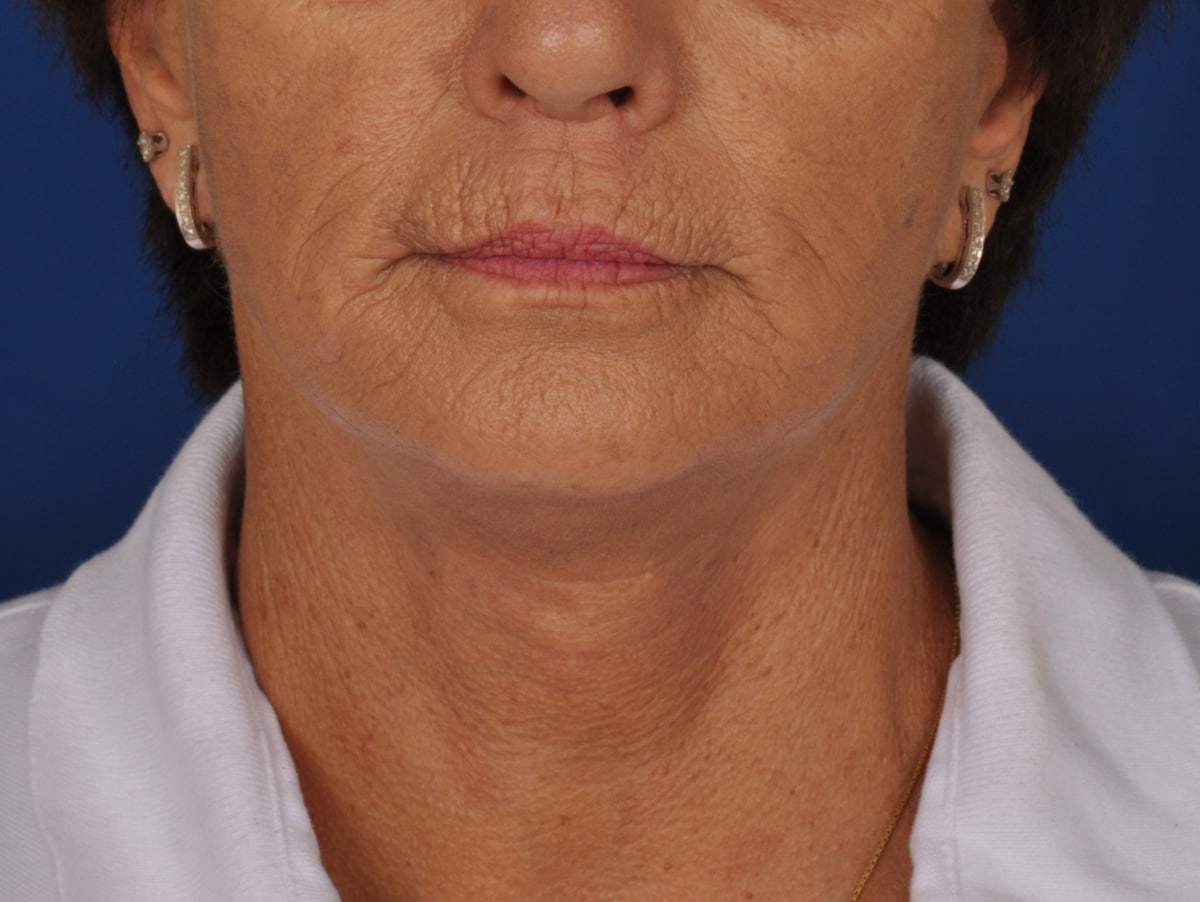 Case 1320 Denver Cosmetic Surgery Board Certified Plastic Surgeon