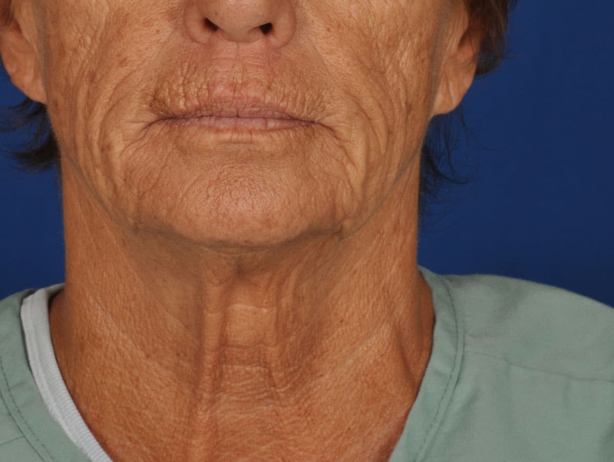 Case--1320 | Before Facelift / Neck Lift