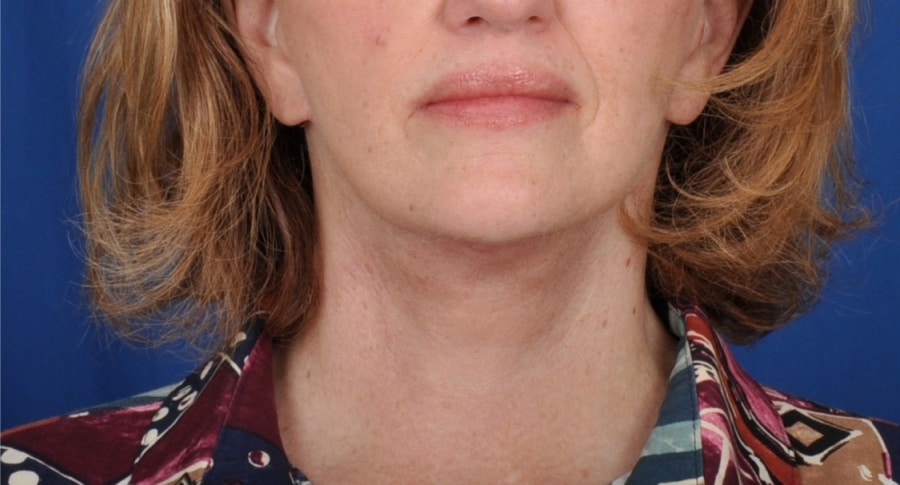 Case--9051 | After Facelift / Neck Lift